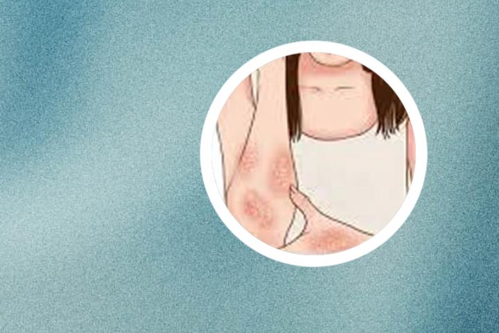 脓疱型银屑病能吸烟吗