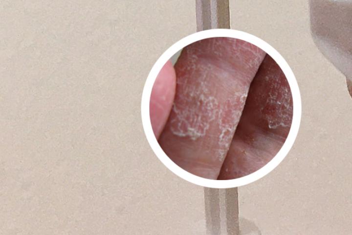 患银屑病的人最后都怎么样了
