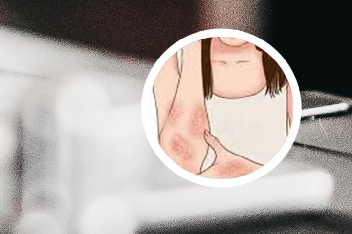 银屑病可以治好吗