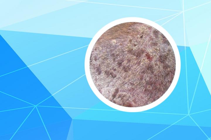 银屑病颜色变成红褐色