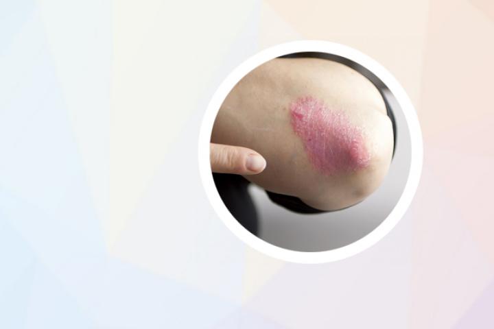 头上牛皮癣可以打疫苗吗