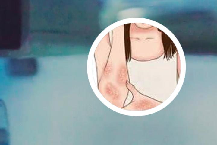 银屑病是怎么得来的