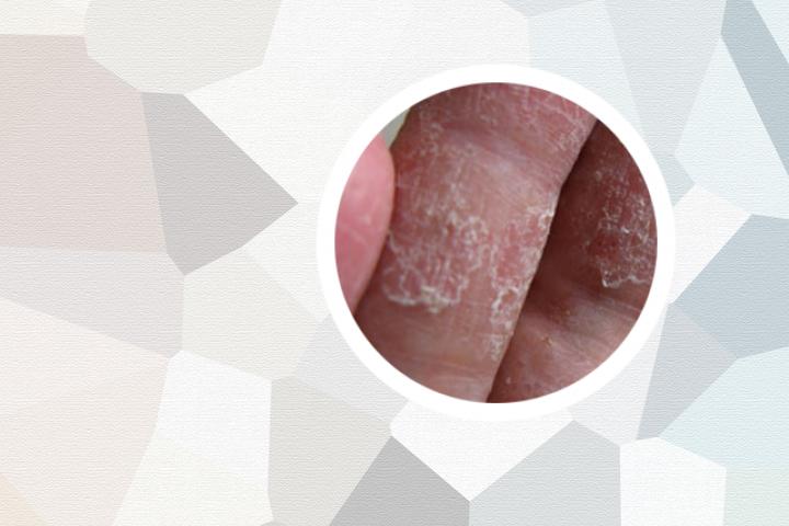 牛皮癣皮损为什么脸上先好