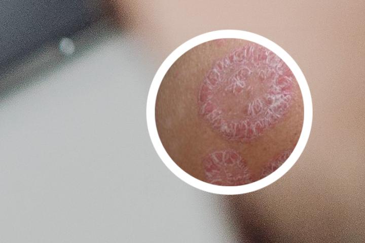 为什么银屑病那么严重呢