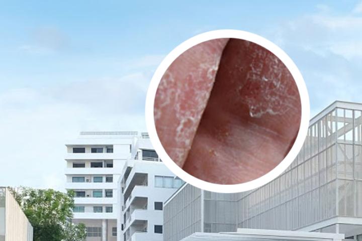 银屑病进口药膏排行榜大全