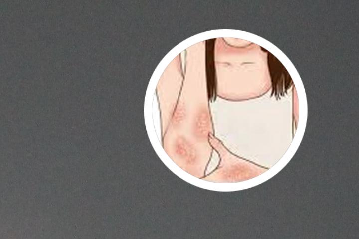 银屑病是不是每年都复发