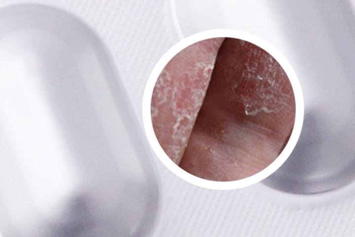阿维a治疗银屑病的最佳服用方法