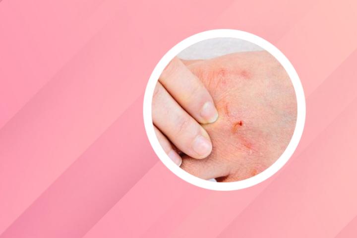 银屑病哪种药膏效果好