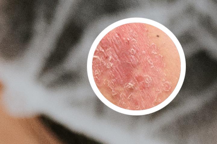 牛皮癣洗面奶排行榜