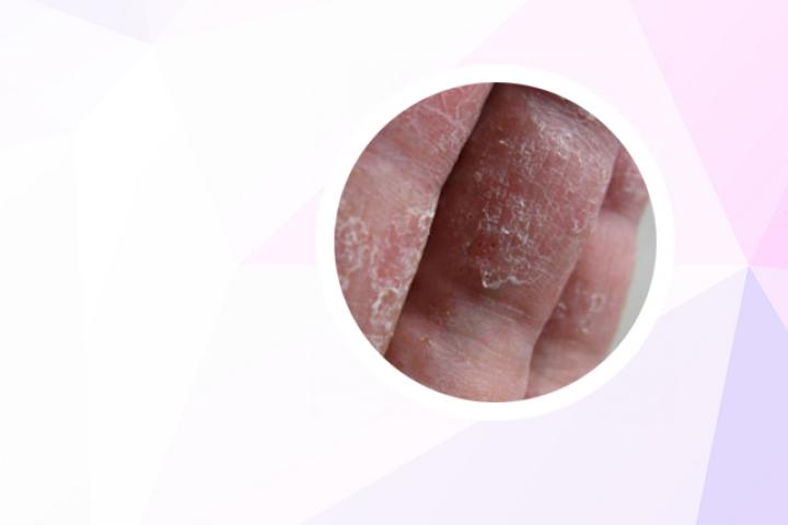 牛皮癣癣治疗农村土办法