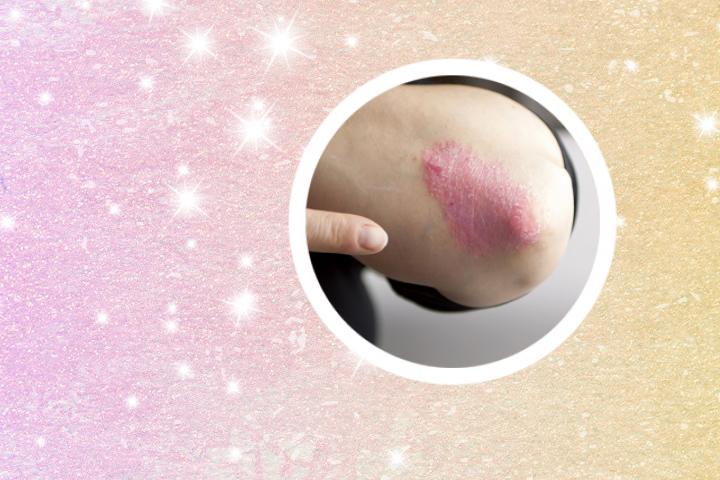 银屑病患者能否使用降糖药进行治疗