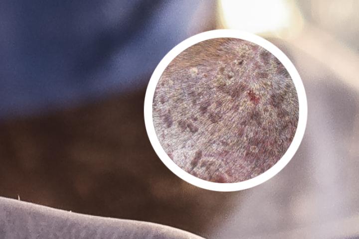 银屑病的药物针剂最新疗效如何