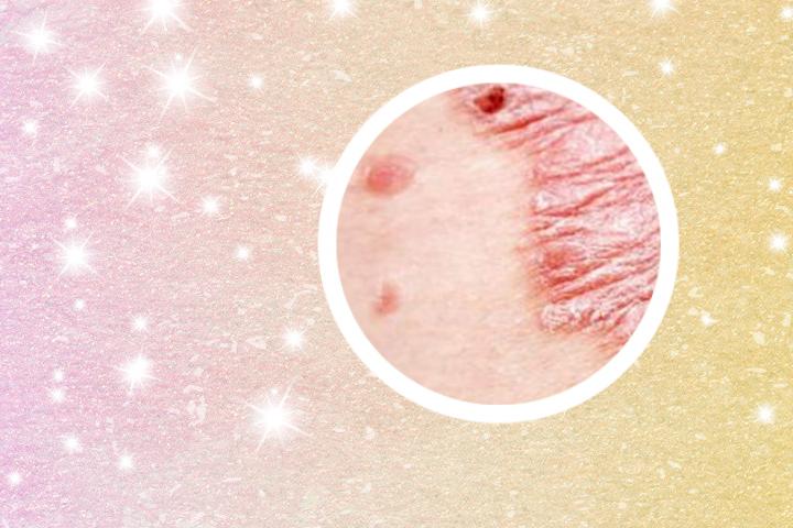 儿童怎么会得银屑病