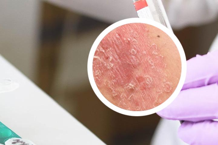 B12肌注治疗对银屑病有效吗