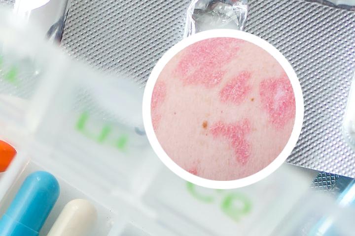 牛皮癣传染概率