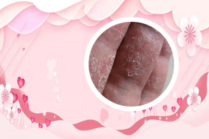 扁桃体引起的银屑病能自愈吗