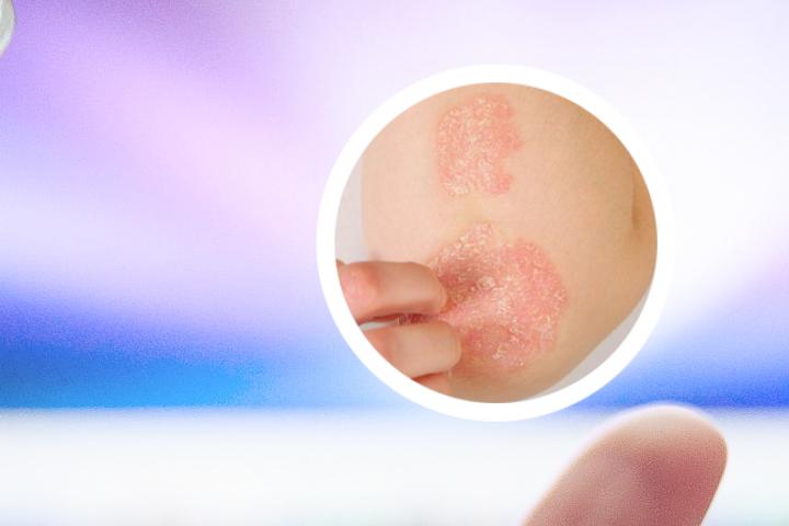 银屑病临床表现视频