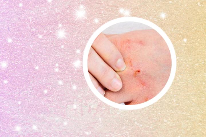 银屑病报告单文字
