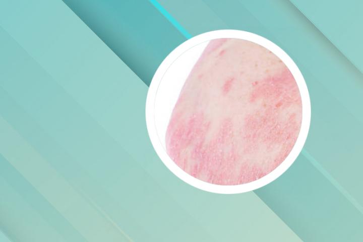 银屑病患者可以享受最新的慢病报销目录吗