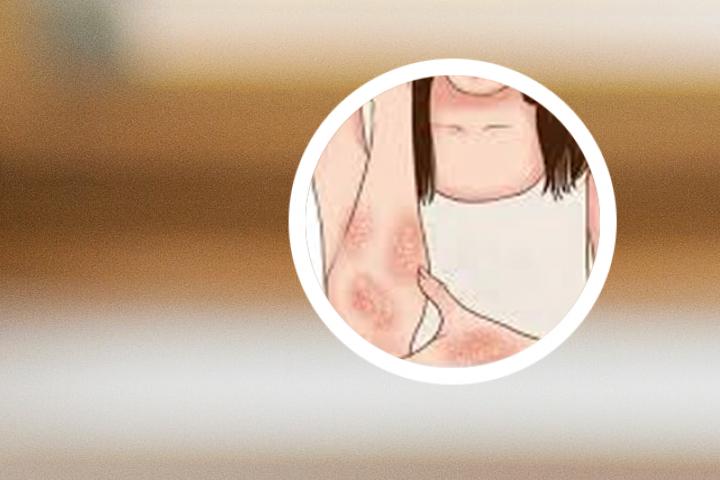 口服头孢克肟可以治疗银屑病吗