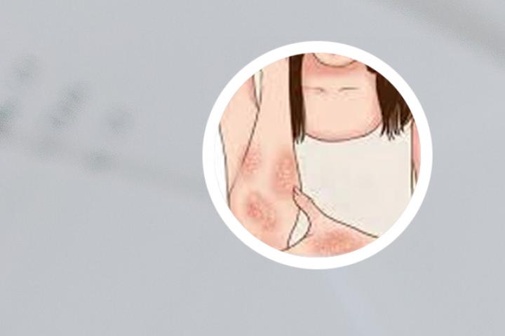 白醋治疗银屑病的偏方