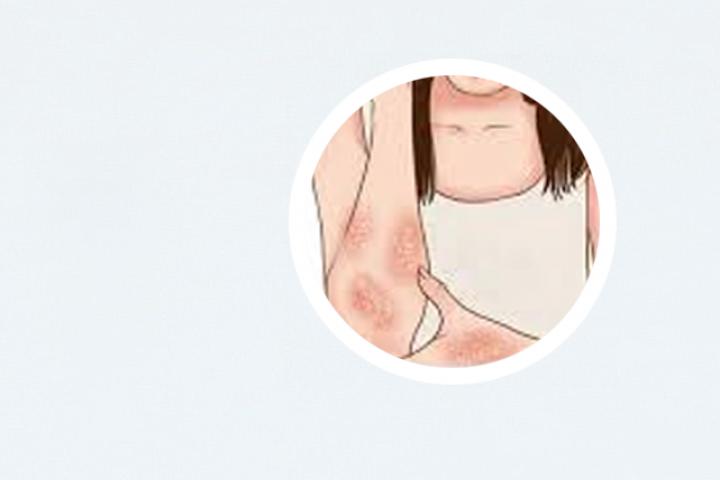 阿维a和什么药配合治银屑病