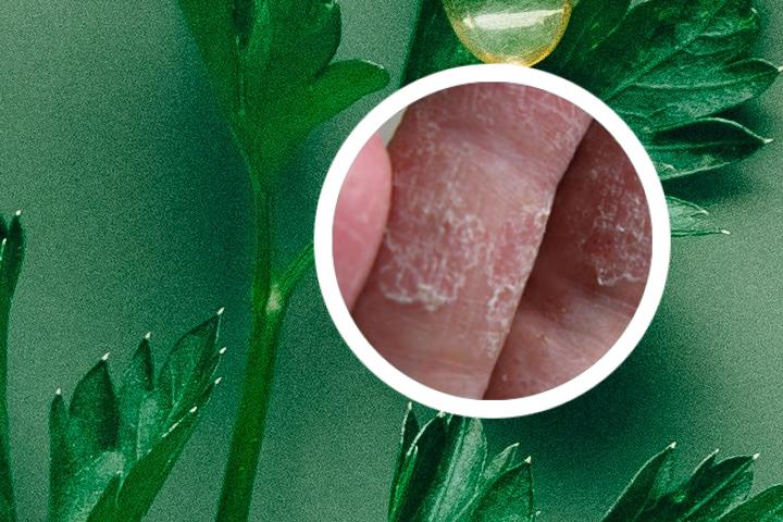 请问醋加蛋黄能否有效治疗银屑病呢