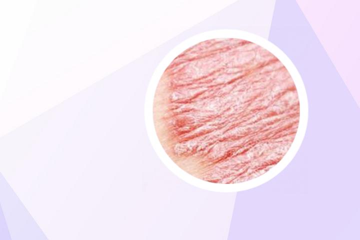 如何进行银屑病的最佳防护
