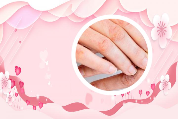 维生素治疗银屑病