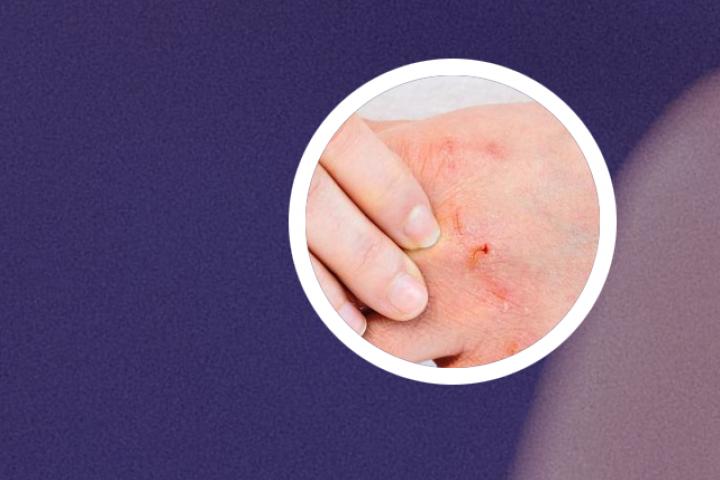 免疫风湿科银屑病治疗