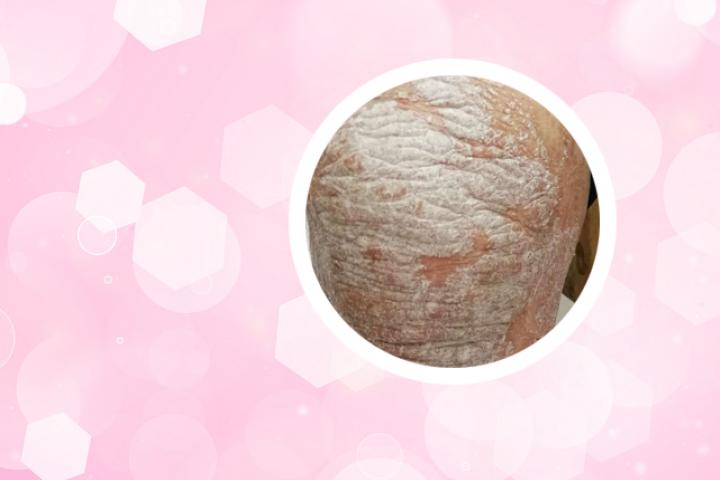 银屑病用308还是311好