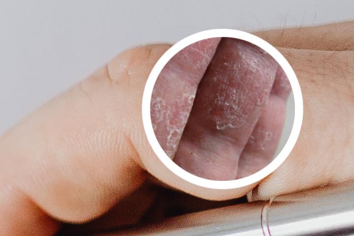 用艾叶熏蒸能治银屑病吗