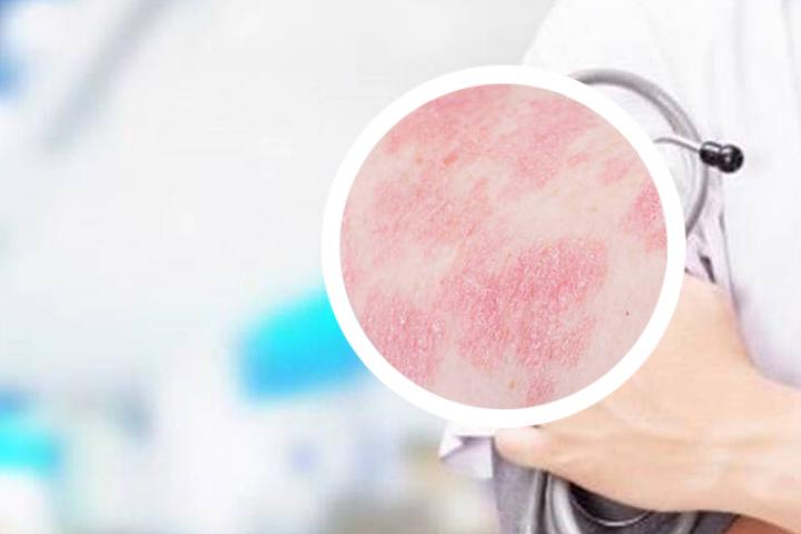 治疗银屑病的药膏