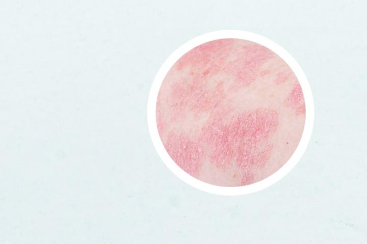 mtx治疗银屑病多长有效果