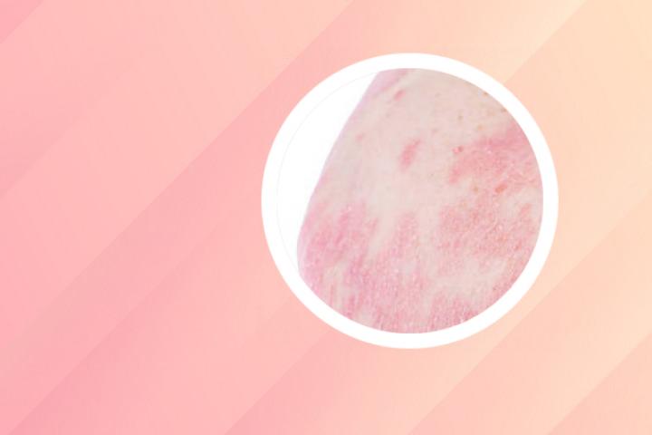 使用马钱子精油可以治疗银屑病吗