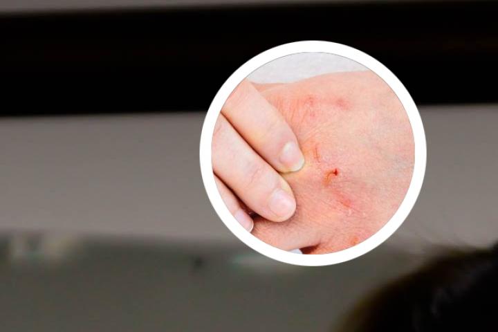 银屑病应该找郑主任治疗吗