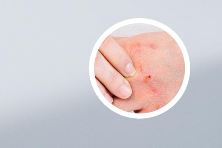 女人得银屑病多吗
