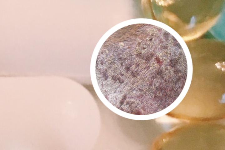 牛皮癣西医效果好还是中医