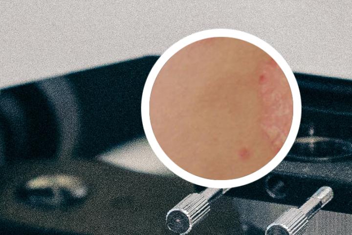 银屑病新药研发成功