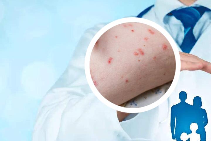 轴型关节型银屑病如何缓解症状