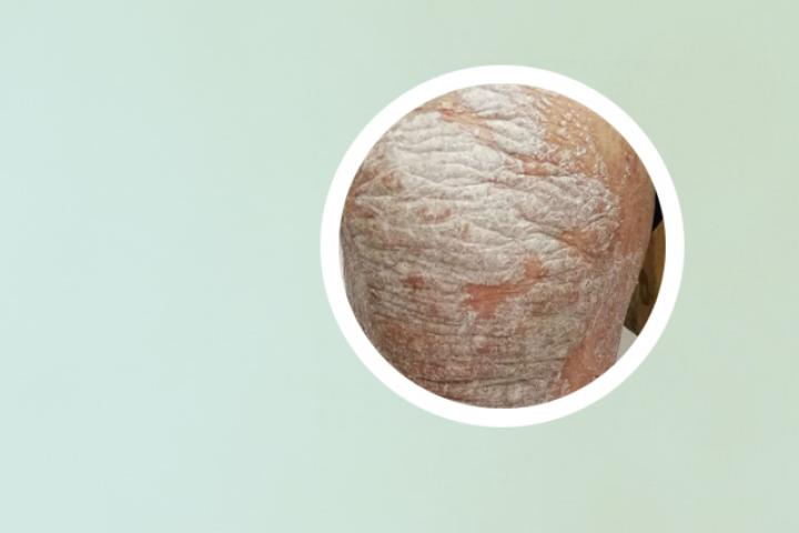 爱宁达能治银屑病吗