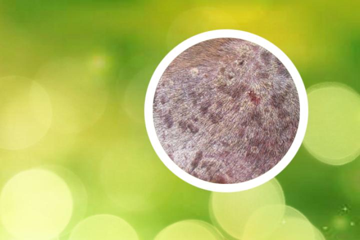 治疗银屑病最新的药物