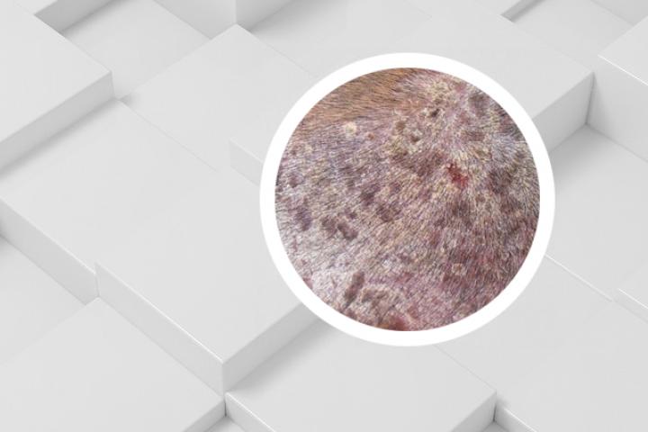 银屑病可以吃蜜糖吗