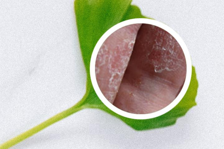 牛皮癣免疫制剂医保报销吗