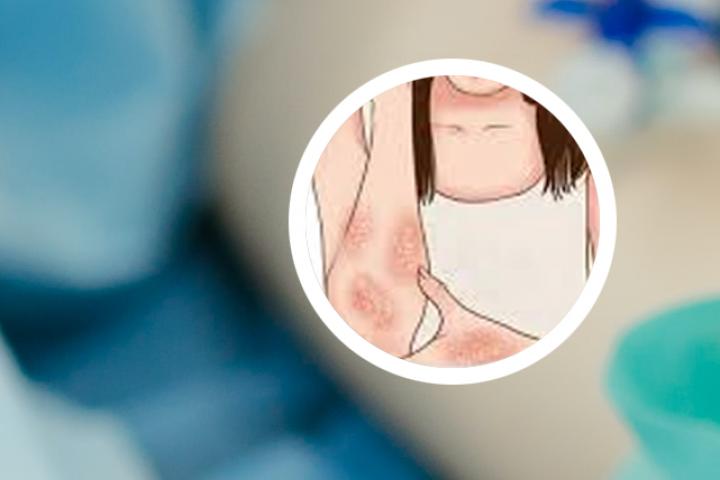 银屑病关节型能够完全好吗