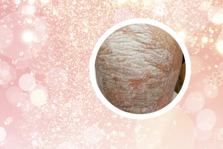小腿上有牛皮癣怎么治
