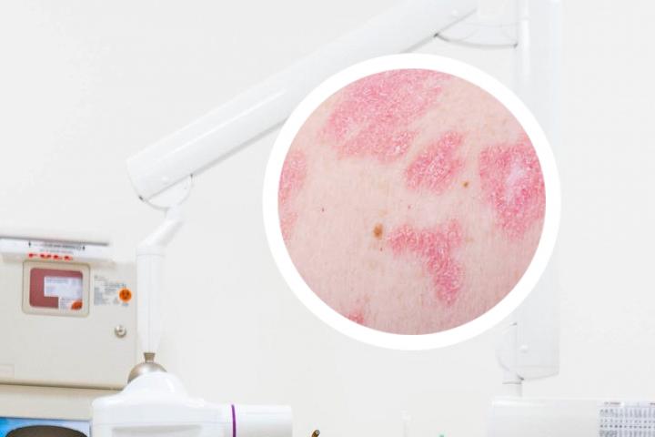 艾草熬水洗治疗银屑病案例