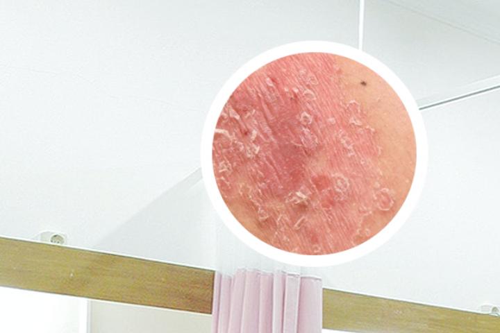手上起的银屑病治不好