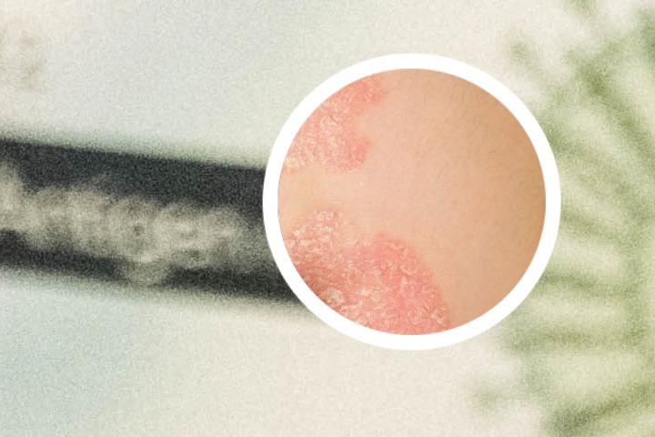 银屑病阴性什么意思
