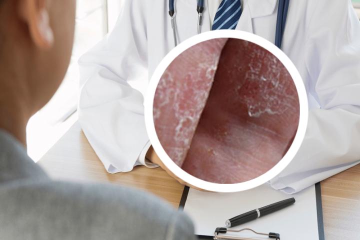 治疗银屑病生物制剂对比